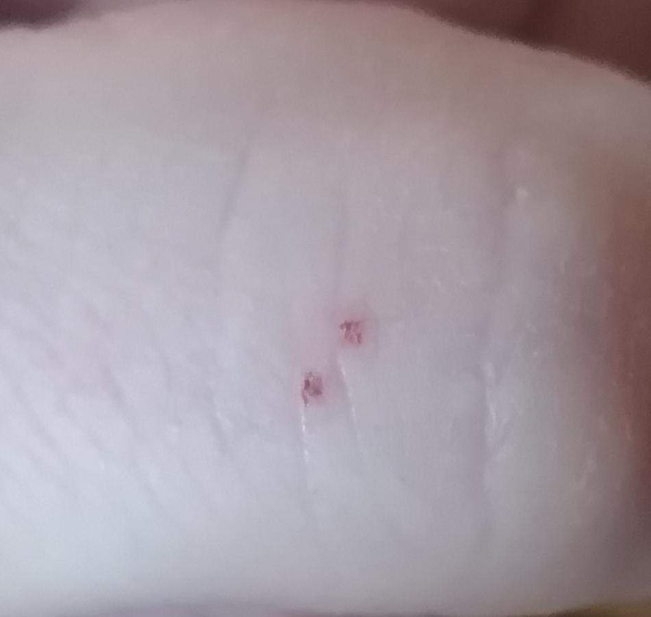 Fledermaus biss? (Gesundheit und Medizin)