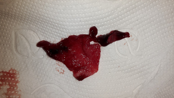 Schmierblutung bräunliche ᐅ Einnistungsblutung
