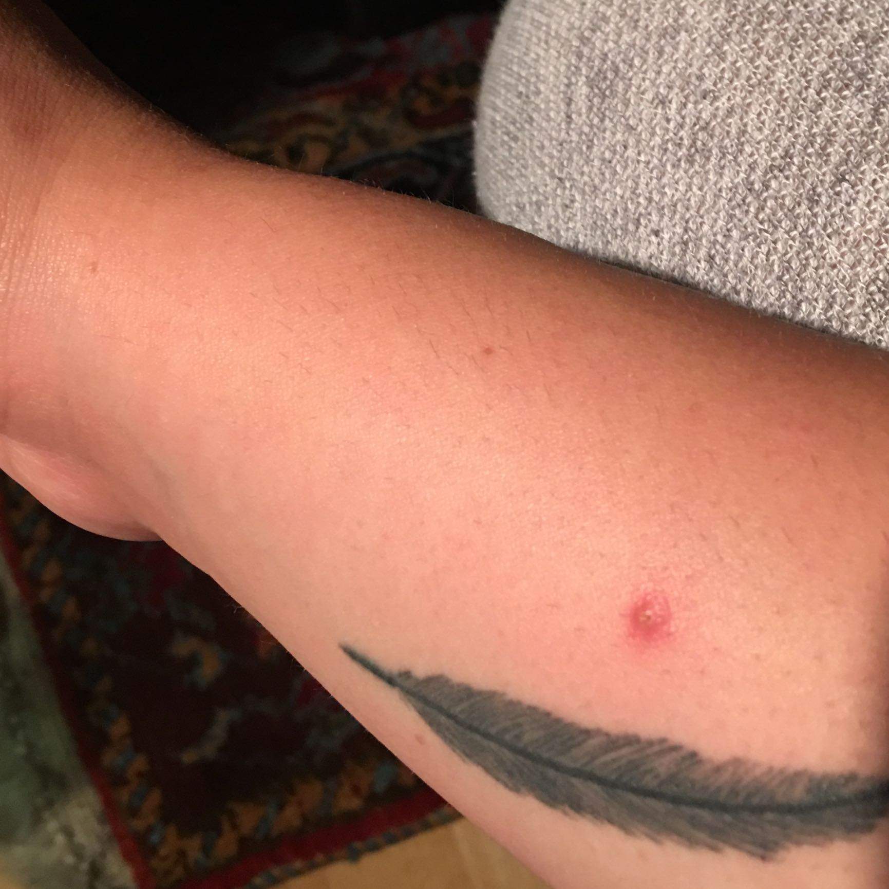 Fliegenstich oder pickel? (Tattoo, Arm, Feder)