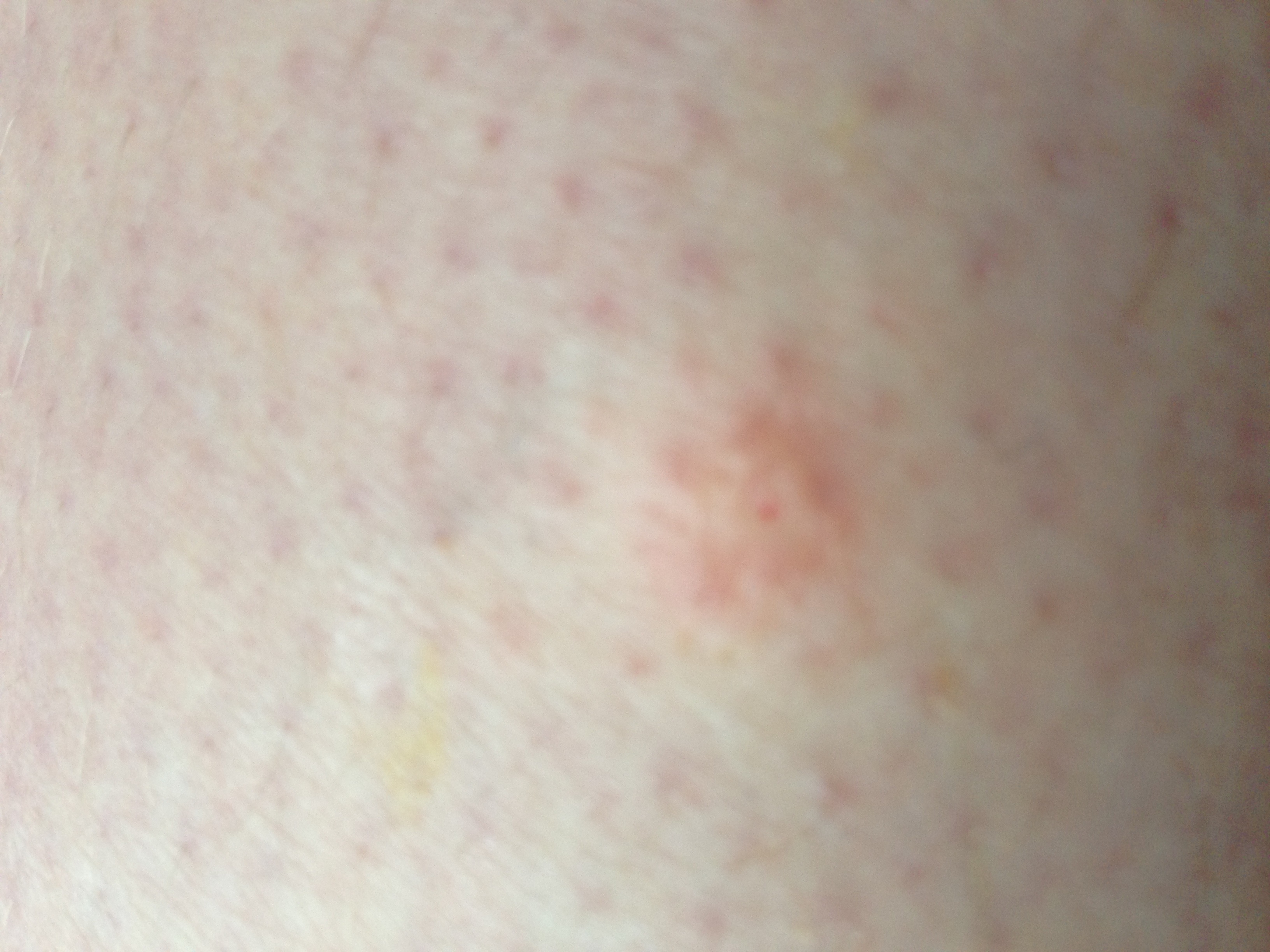 Flohbiss? Mückenstich? Irgendwas anderes? (Gesundheit, Mücken, Stich)