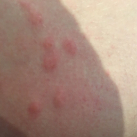 Flohbisse Auf Der Haut Gesundheit Und Medizin Tiere Arzt