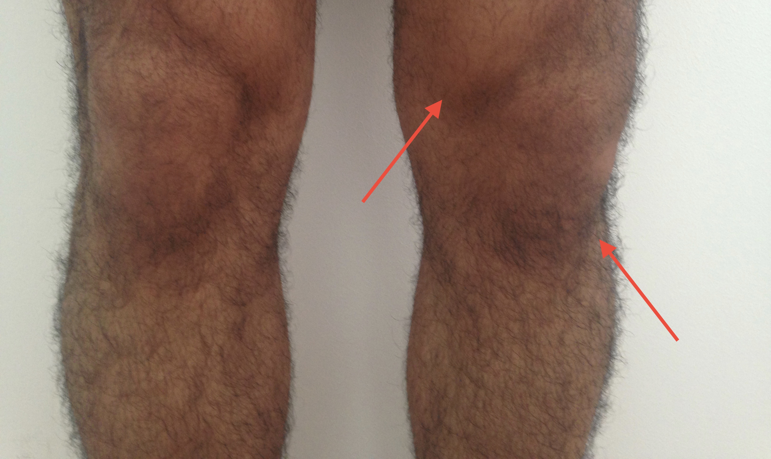 Flüssigkeitansammlung am Knie und Schmerzen! MRT und Röntgen NEGATIV. Wer hat ähnliches erlebt ...