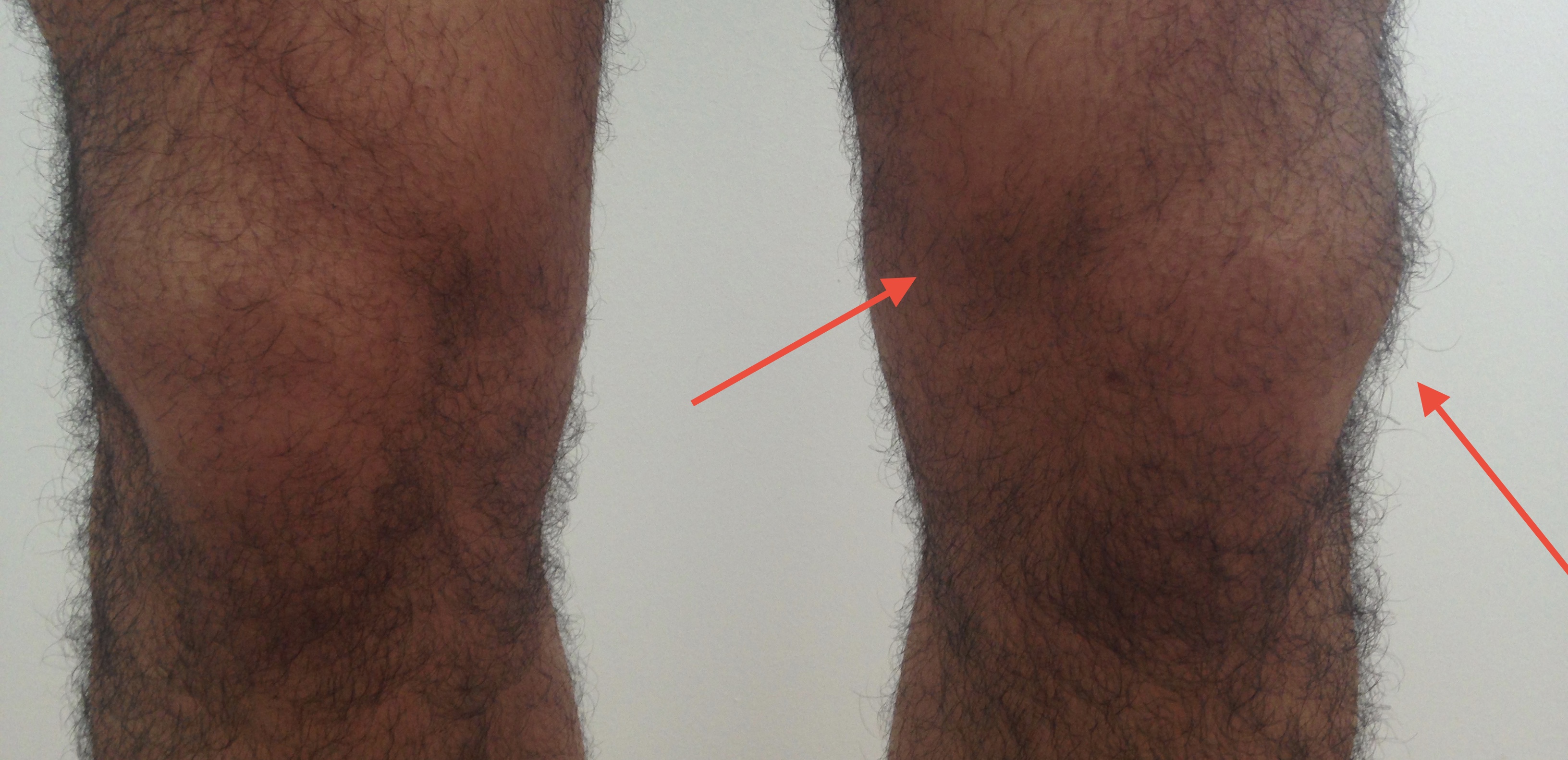 Flüssigkeitansammlung am Knie und Schmerzen! MRT und Röntgen NEGATIV. Wer hat ähnliches erlebt ...