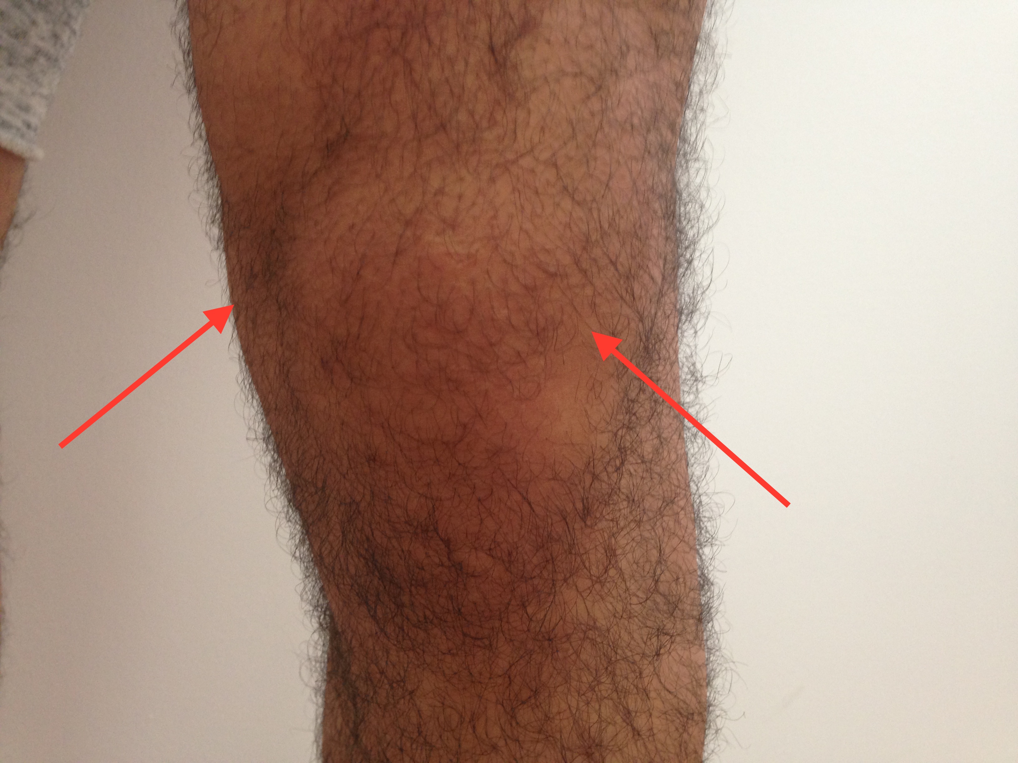 Flüssigkeitansammlung am Knie und Schmerzen! MRT und Röntgen NEGATIV