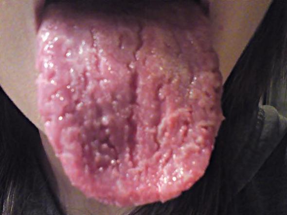 Meine Zunge! - (Gesundheit, Arzt, Mund)