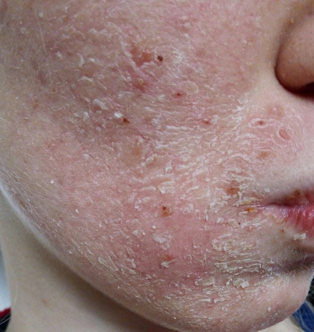 Folgen Von Curacne Akne Behandlung Gesundheit Und Medizin Hautarzt