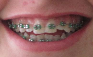 Frage! hilfee wichtig (Zahnspange, Gummi)