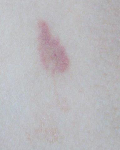 - (Gesundheit, Medizin, Zecken)