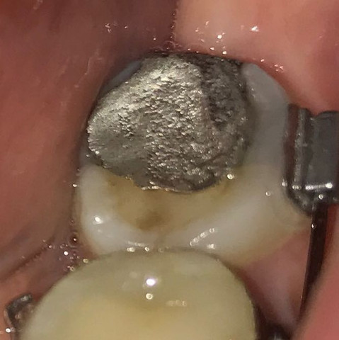 Zahn  - (Schmerzen, Zähne, Zahnarzt)