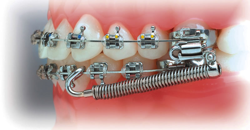 Fragen an Zahnspangenträger mit Feder (Arzt, Zahnspange)