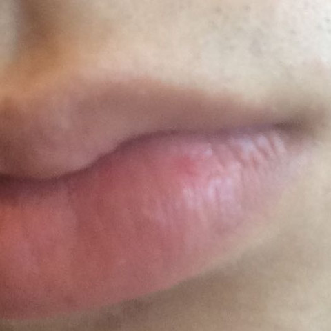 Fragen Zu Herpes Krankheit Pickel Kussen