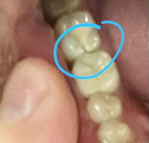 Fraktur am Zahn, Notfall?
