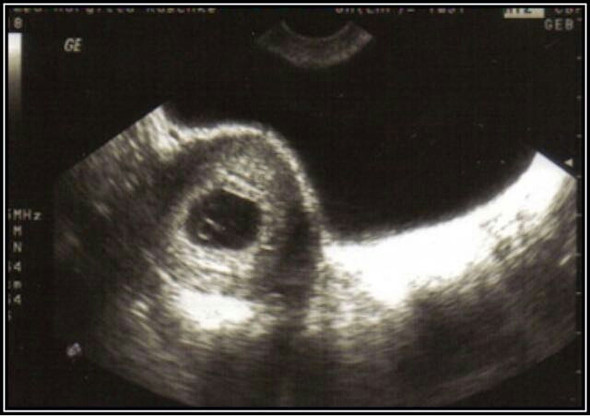 Ultraschall - (Schwangerschaft, Gebärmutter, Wölbung)