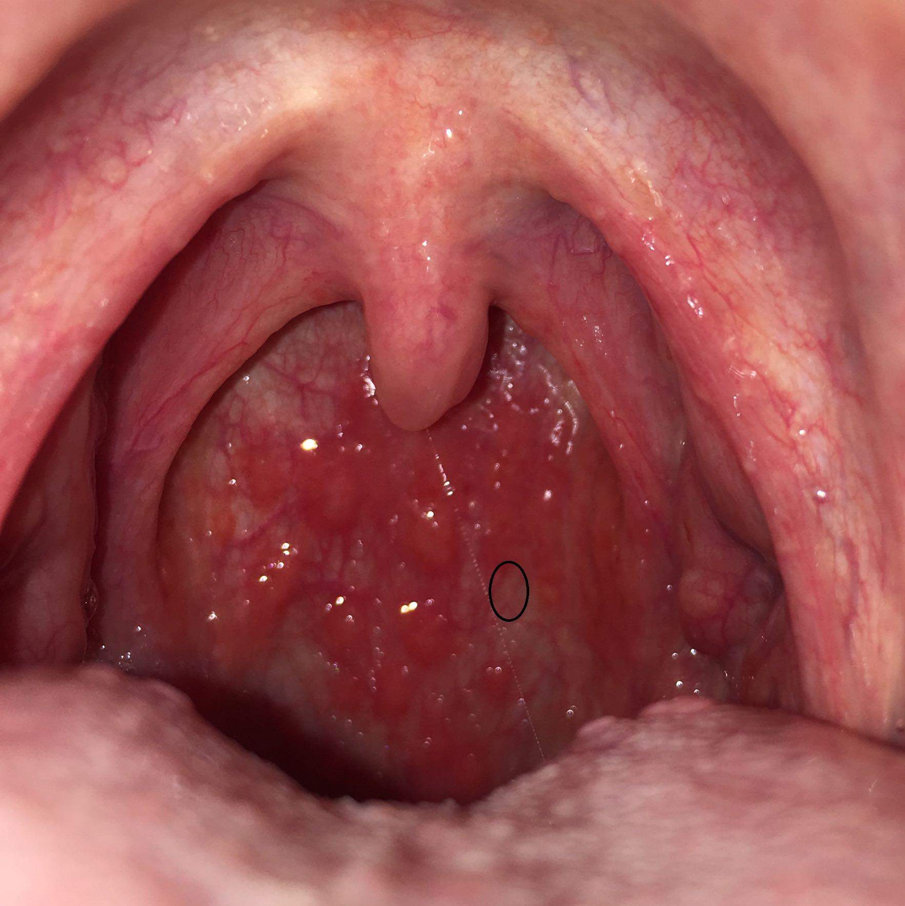 Mandelsteine Entfernen Ohne Wurgen Mandelsteine Entfernen Ohne Wurgen