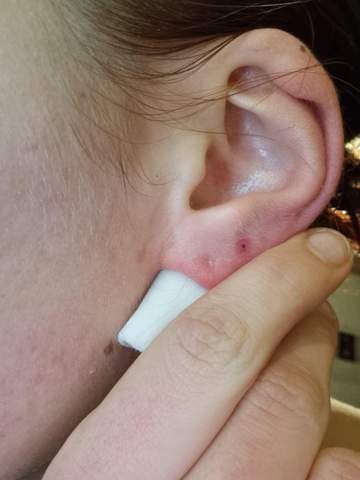 Frisches Ohrloch entzündetwas tun? (Schmerzen, Piercing, Entzündung)