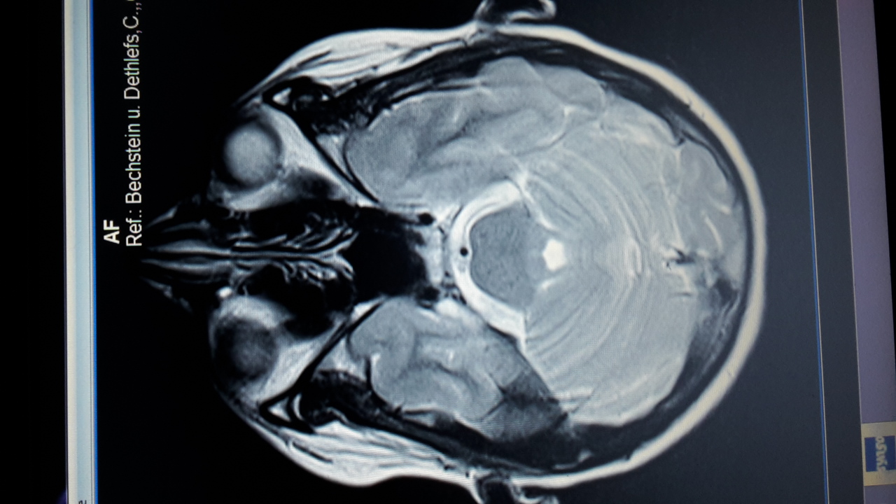 Frontotemporale Demenz, Demenz? (Neurologie, MRT)