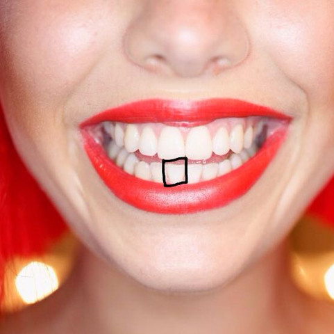Fullung Am Zahn Griege Eine Zahnspange Tut Das Nicht Weh Zahne