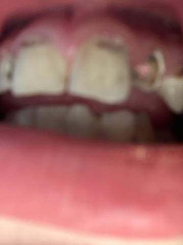 Füllung aus Zahn?