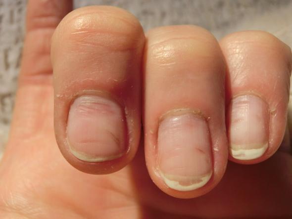 Furchen In Den Fingernageln Ernahrung Medizin Kosmetik