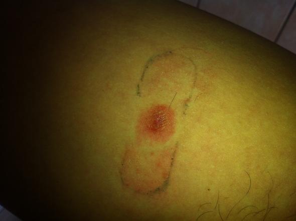Furunkel Muttermal Abszess Pickel Am Oberschenkel Innen Gesundheit Hautkrebs Furunkel Muttermal Abszess Pickel Am Oberschenkel Innen Gesundheit Hautkrebs