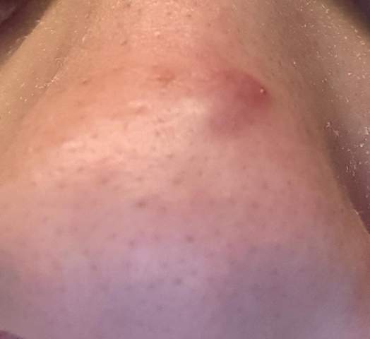 Furunkel Tut Aber Nicht Weh Gesundheit Korper Pickel Furunkel Tut Aber Nicht Weh Gesundheit Korper Pickel