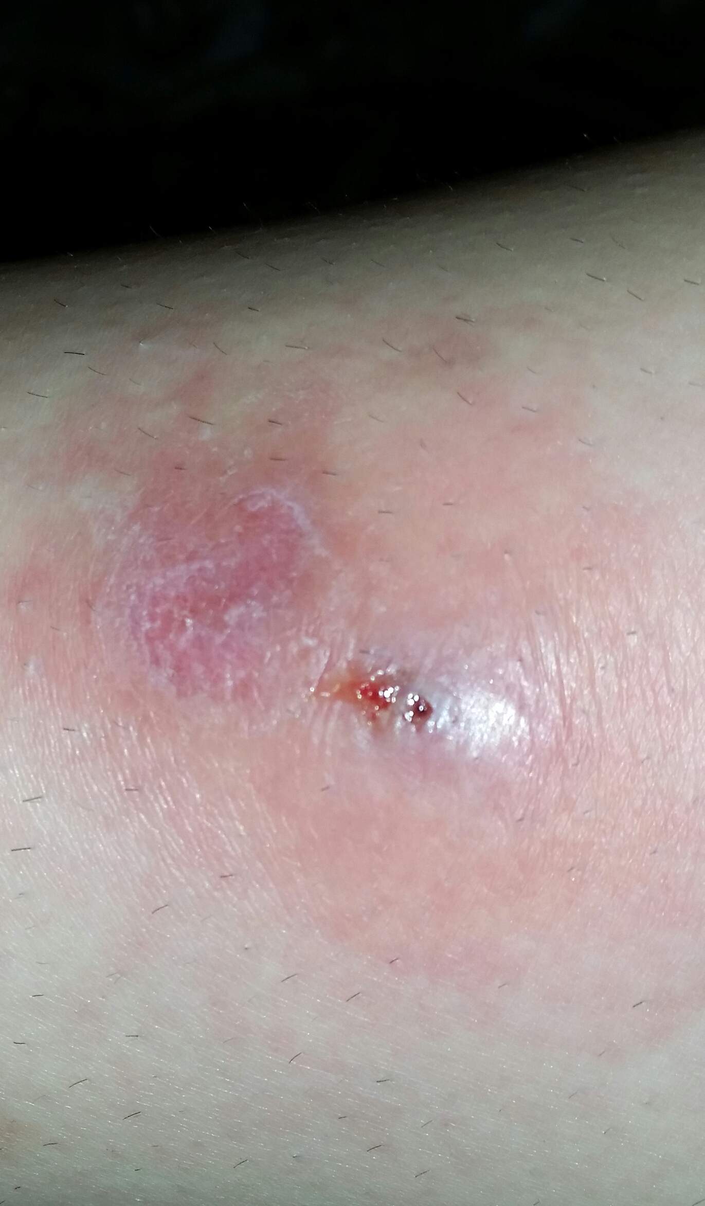 furunkel was tun bis am montag (Medizin, Arzt, Krankheit)