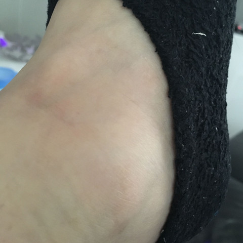 Mein Fuß von der Seite, Tag 3 - (Füße, Verletzung, Knochen)