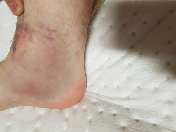 Fuß durch stoß stark blau? (gesundheit und medizin, füße, schwellung) Fuß durch Stoß stark blau? (Gesundheit und Medizin, Füße, Schwellung)