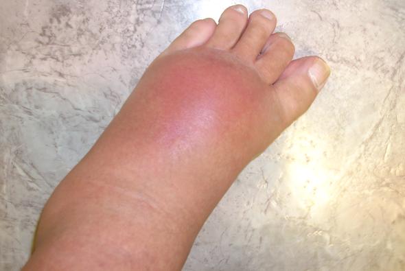 Fuß geschwollen gicht Rheuma Anzeichen:
