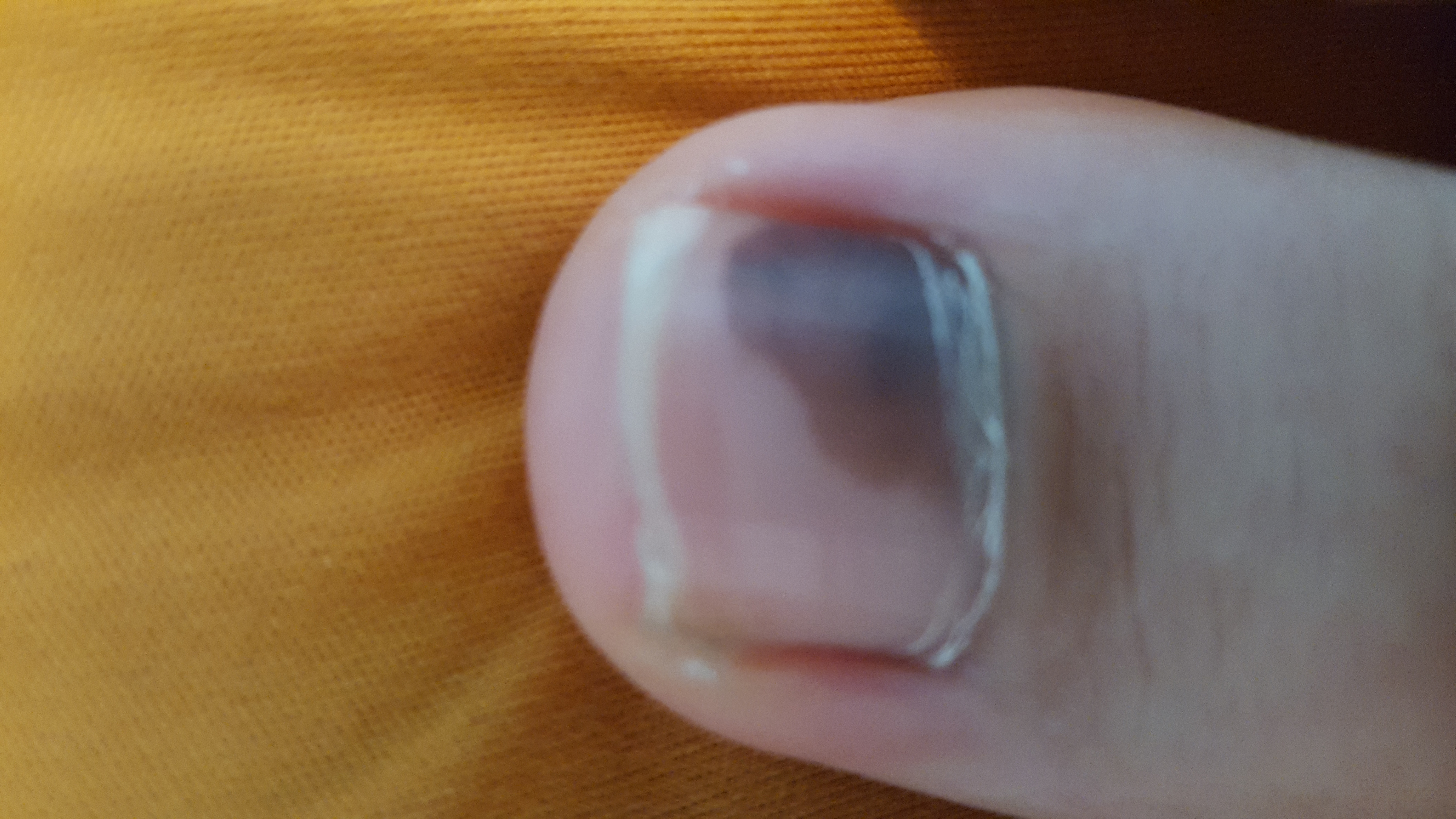 Fuss Nagel Geklemmt Wird Der Nagel Rausfallen Oder So Bild Gesundheit Zehennagel Fuss Nagel Geklemmt Wird Der Nagel Rausfallen Oder So Bild Gesundheit Zehennagel