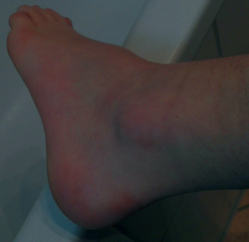 Fuss Ruhigstellen Schmerzen Fusse Orthopade