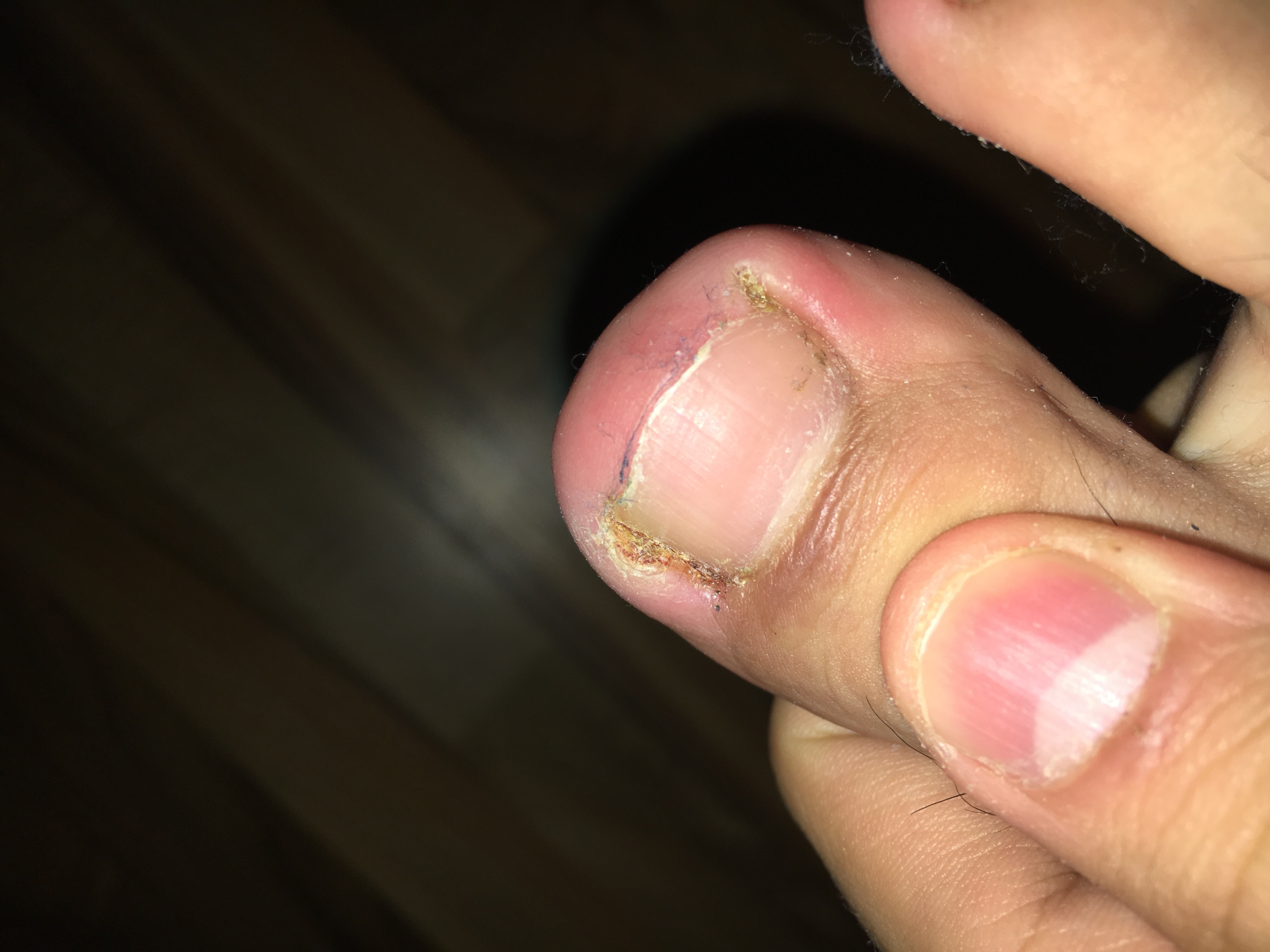 Fuß schmerz nagel schmerzt (foto) ohne arzt bitte? (Gesundheit und
