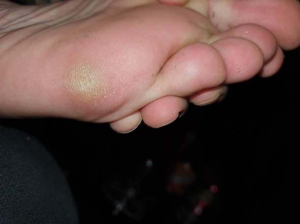 Fuss Schmerzen Unter Dem Klein Zeh Fusse Fuss Schmerzen Unter Dem Klein Zeh Fusse