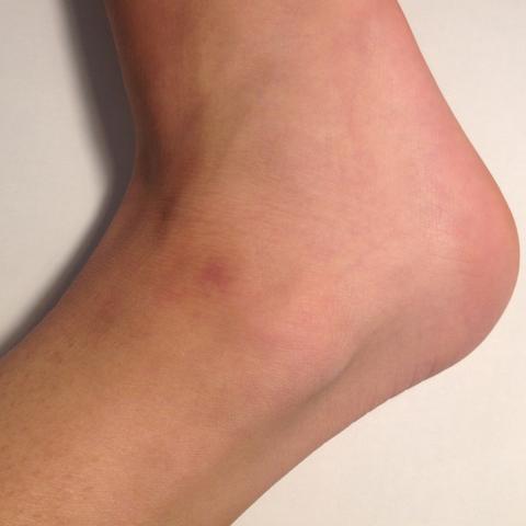 Fuss Umgeknickt Etwas Ernstes Arzt Fusse Knochel Fuss Umgeknickt Etwas Ernstes Arzt Fusse Knochel