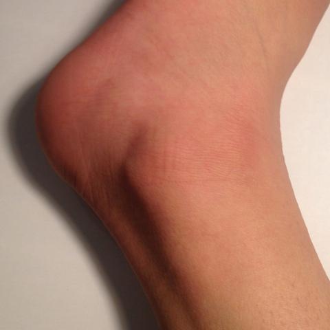 Fuss Umgeknickt Etwas Ernstes Arzt Fusse Knochel Fuss Umgeknickt Etwas Ernstes Arzt Fusse Knochel