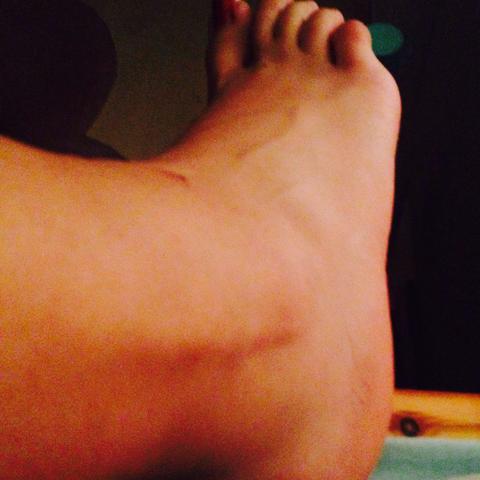 Fuss Umgeknickt Pochender Schmerz Nach Einem Und Schwellung Schmerzen Fusse Band