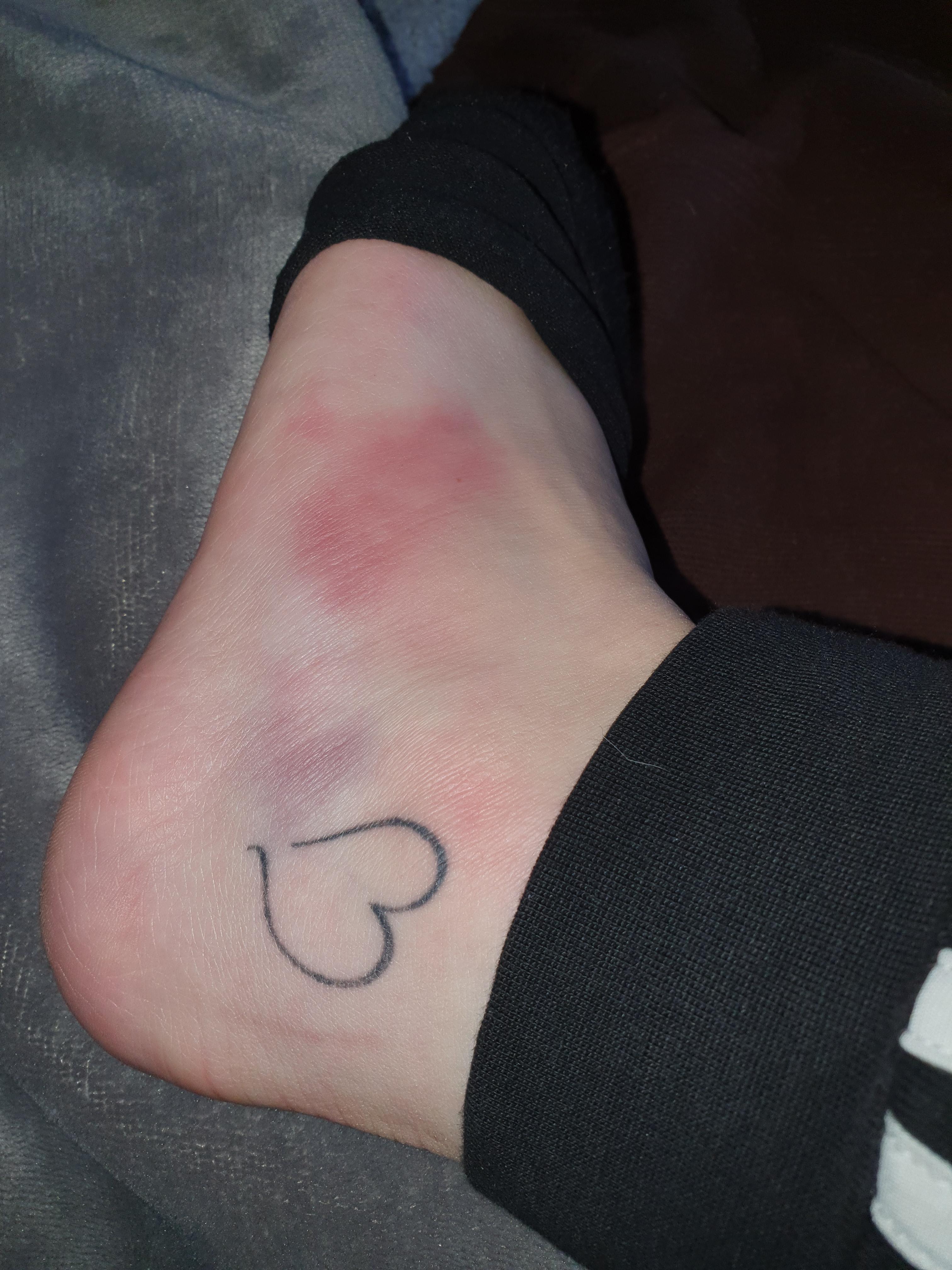 Fuss Umgeknickt Soll Ich Zum Arzt Gesundheit Und Medizin Fuss Umgeknickt Soll Ich Zum Arzt Gesundheit Und Medizin