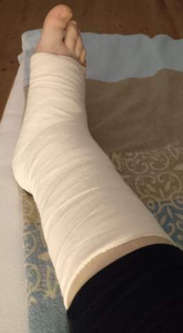 Fuss Verstaucht Und Angerissenes Band Gesundheit Und Medizin Arzt Schmerzen