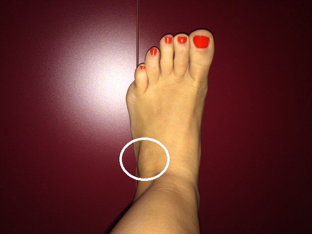 Fuß verstaucht? Verrenkt? Bänderdehnung? (Sport, Fußball