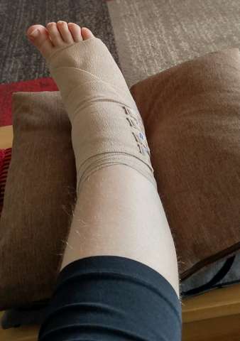 Fussgelenk Verstaucht 3 Gesundheit Und Medizin Schmerzen Fusse