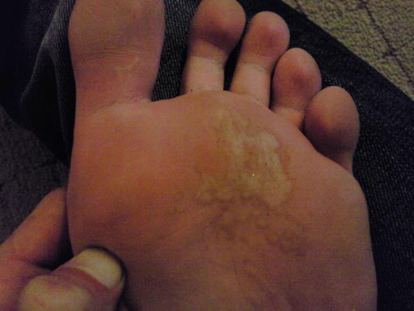 später befallener Fuß (leicht weißlicher Glanz) - (Krankheit, Haut, Füße)