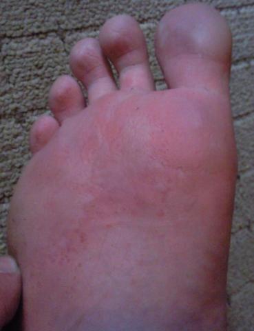 stärker befallener Fuß / Zehenspitzen + Sohle - (Krankheit, Haut, Füße)