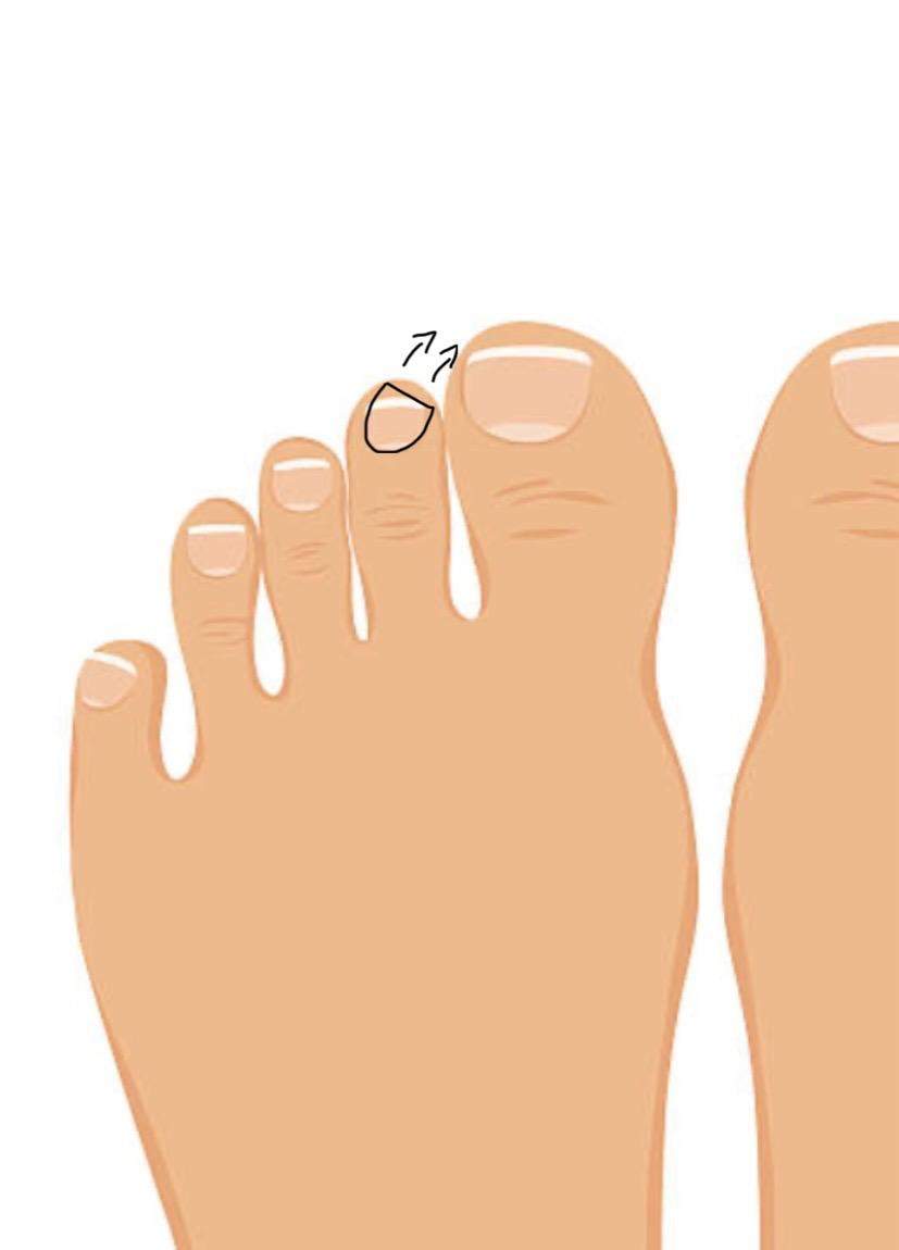 Fußnagel wachsen schief? (Körper, Füße, Nägel)