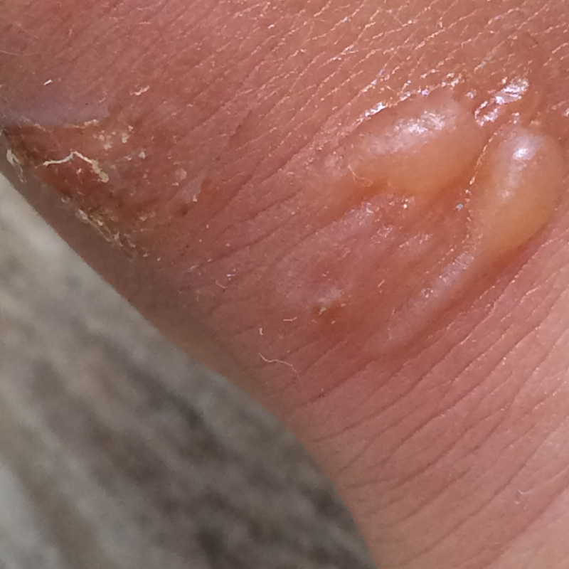 Fußpilz? Oder was ist es? (Ähnlichkeit) Fußpilz? Oder was ist es? (Ähnlichkeit)