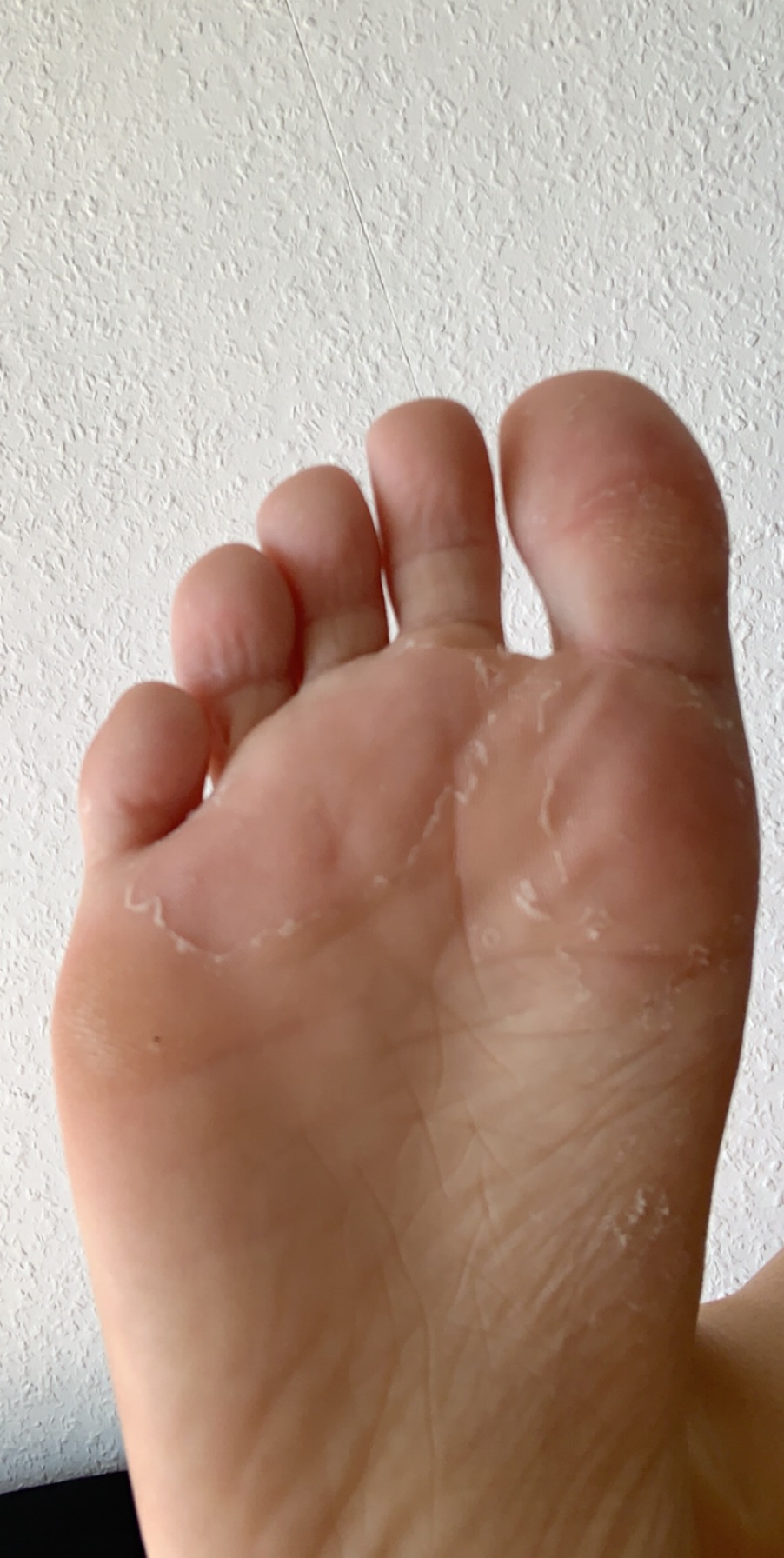 Fußpilz aber kein jucken? (Gesundheit und Medizin, Pilze, Hornhaut)