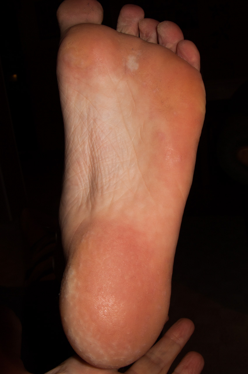 Kann Fußpilz Von Alleine Weggehen Fußpilz oder Hornhaut (Orthopäde, Sprunggelenk, Sportverletzung)