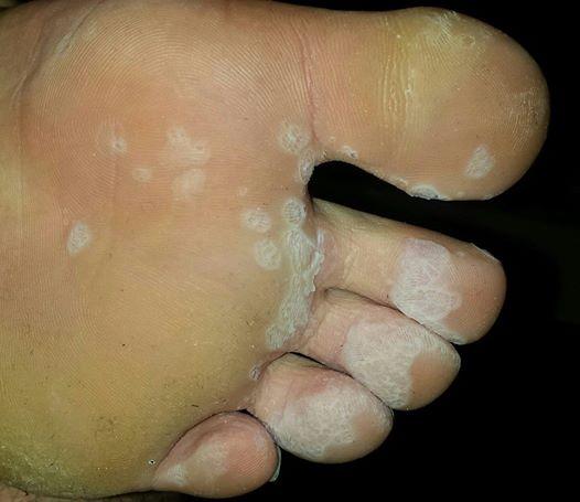 Fusspilz Oder Nur Schuhe Wechseln Fusse Pilze Fusspilz Oder Nur Schuhe Wechseln Fusse Pilze