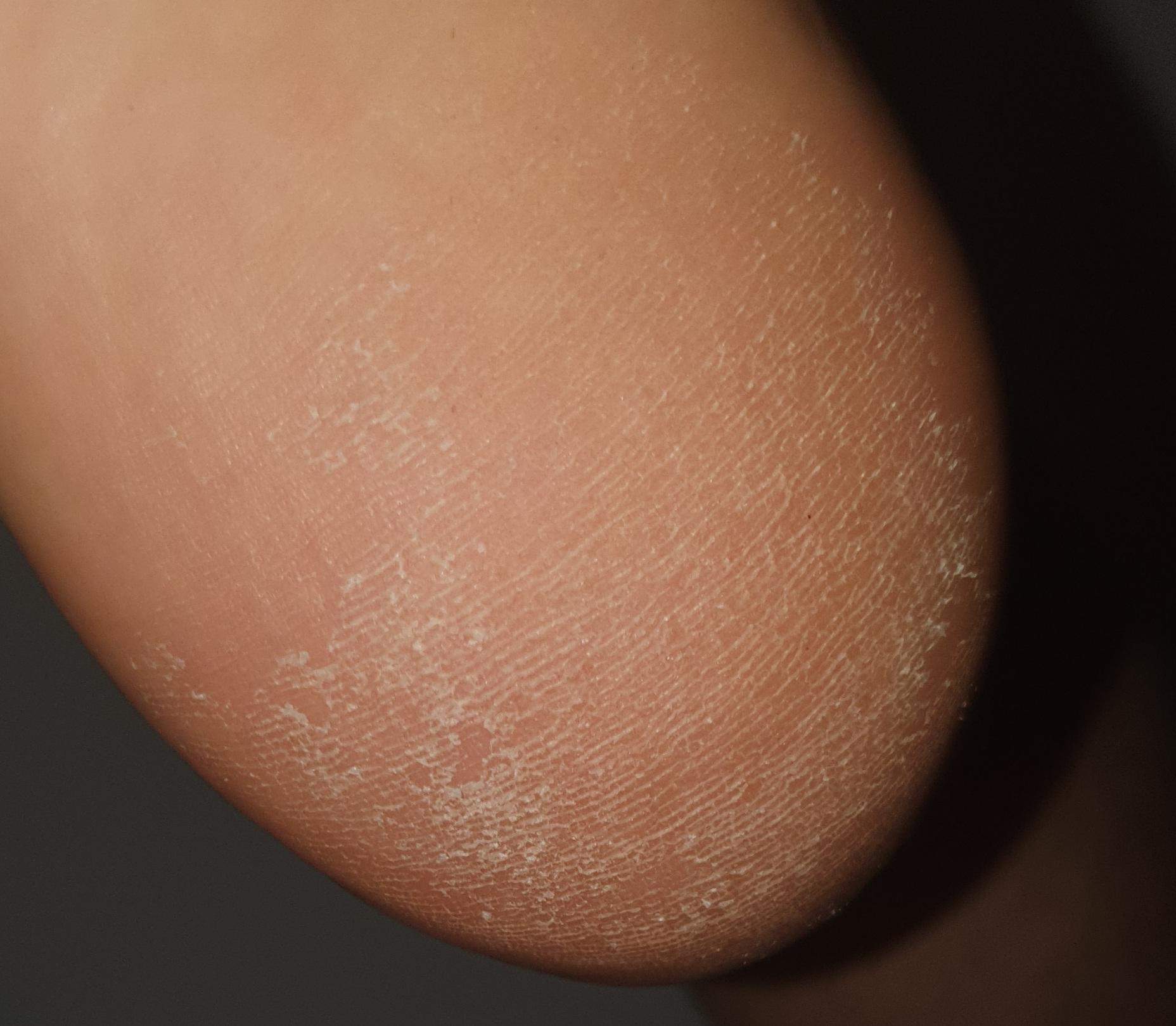 Fußpilz oder nur trockene Haut? (Gesundheit und Medizin, Menschen ...