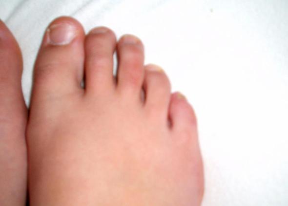 mittlerer Fußzeh - (Gesundheit, Füße, Bruch)