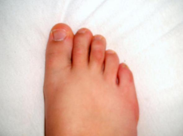 mittlerer Fußzeh - (Gesundheit, Füße, Bruch)